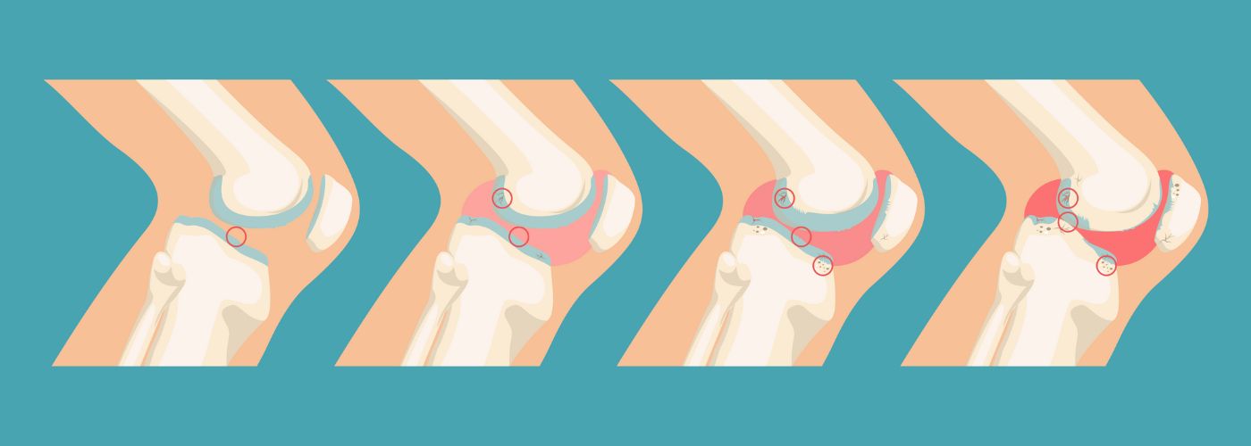 What Is Osteoarthritis