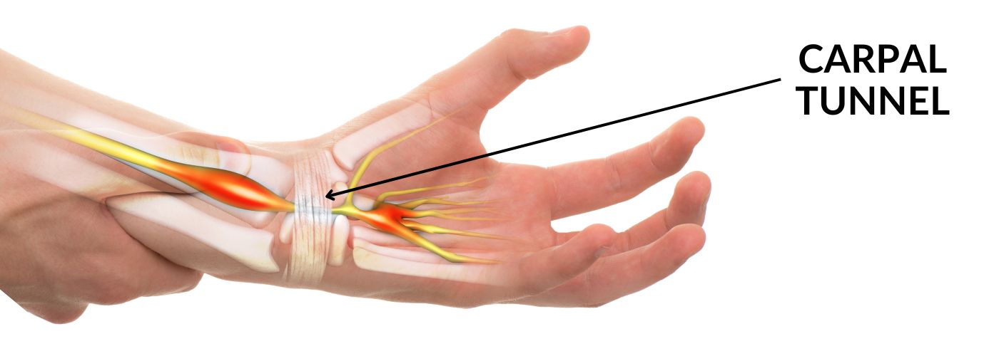DR-HO'S TENS Pad Placement Guide for Carpal Tunnel-Related Pain